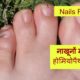 Homeopathic treatment for Nail Fungus