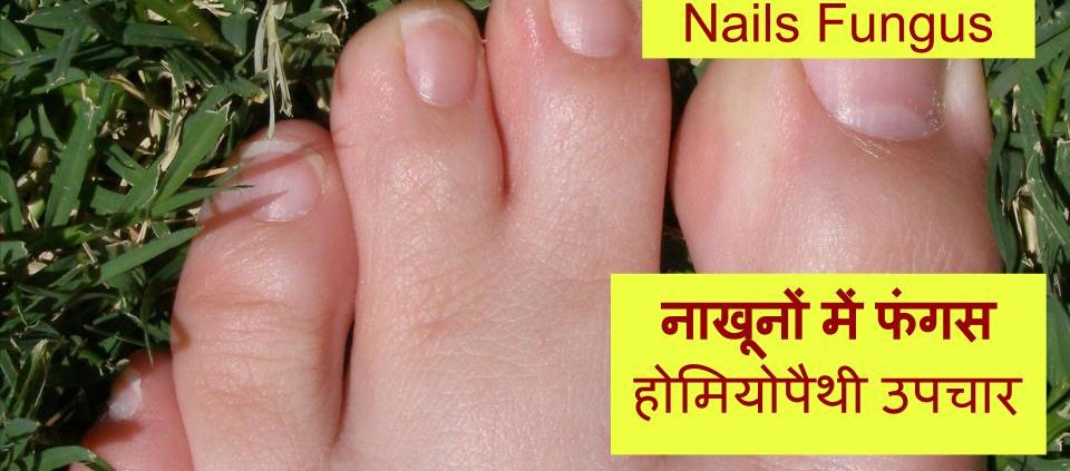 Homeopathic treatment for Nail Fungus