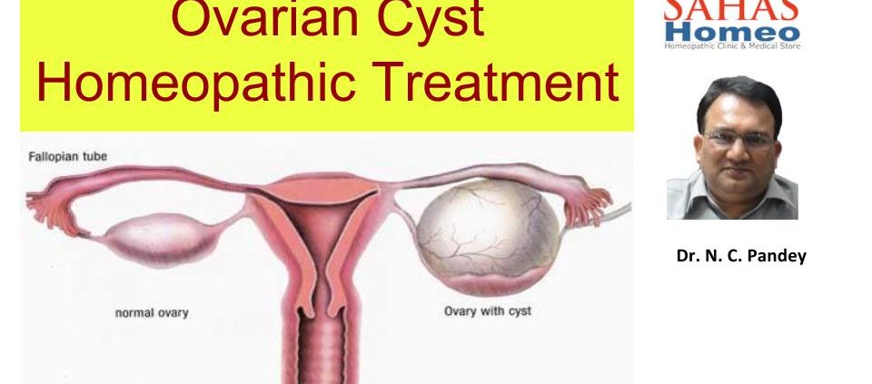 homeopathic treatment for Ovary Cyst