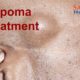 lipoma treatment by homeopathy