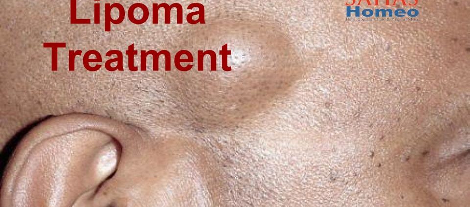 lipoma treatment by homeopathy