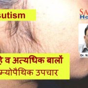 Homeopathic treatment for Hirsutism