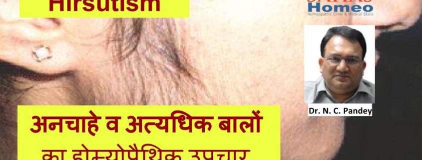 Homeopathic treatment for Hirsutism