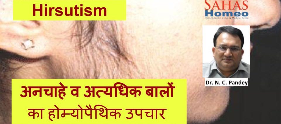 Homeopathic treatment for Hirsutism