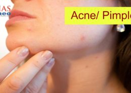 Acne and Pimple treatment
