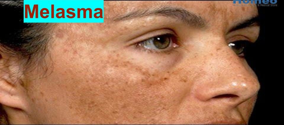 Melasma treatment in homeopathy