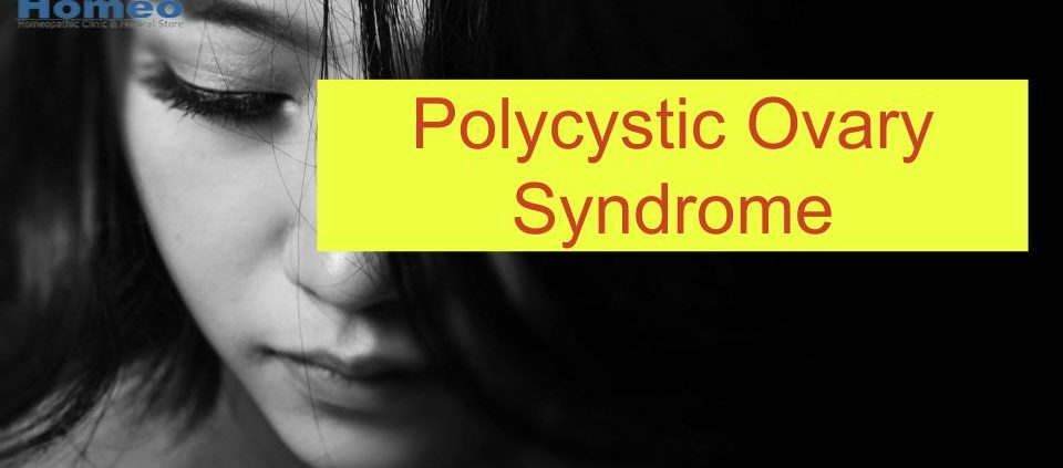 Polycystic ovary syndrome treatment