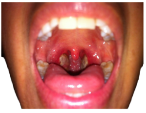 Tonsil Treatment in Homeopathy 