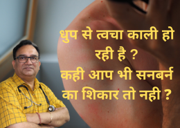 sunburn treatment in homeopathy