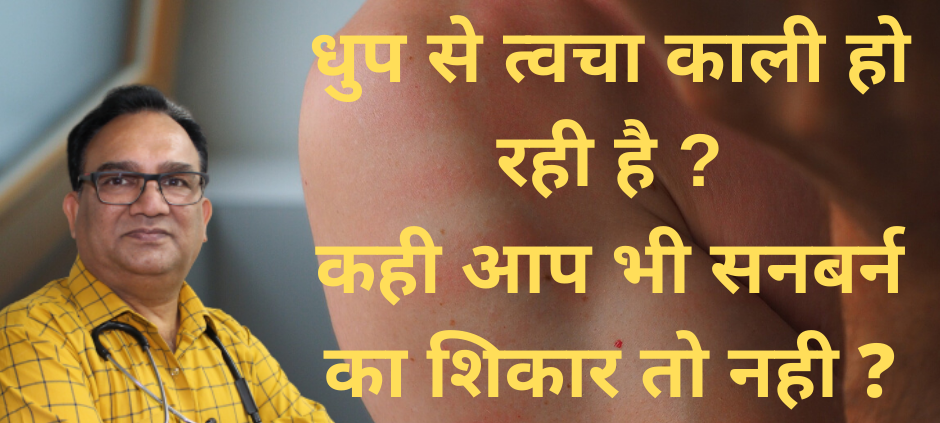 sunburn treatment in homeopathy