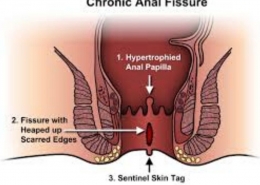 anel fissure treatment in homeopthy