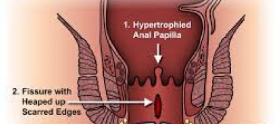 anel fissure treatment in homeopthy