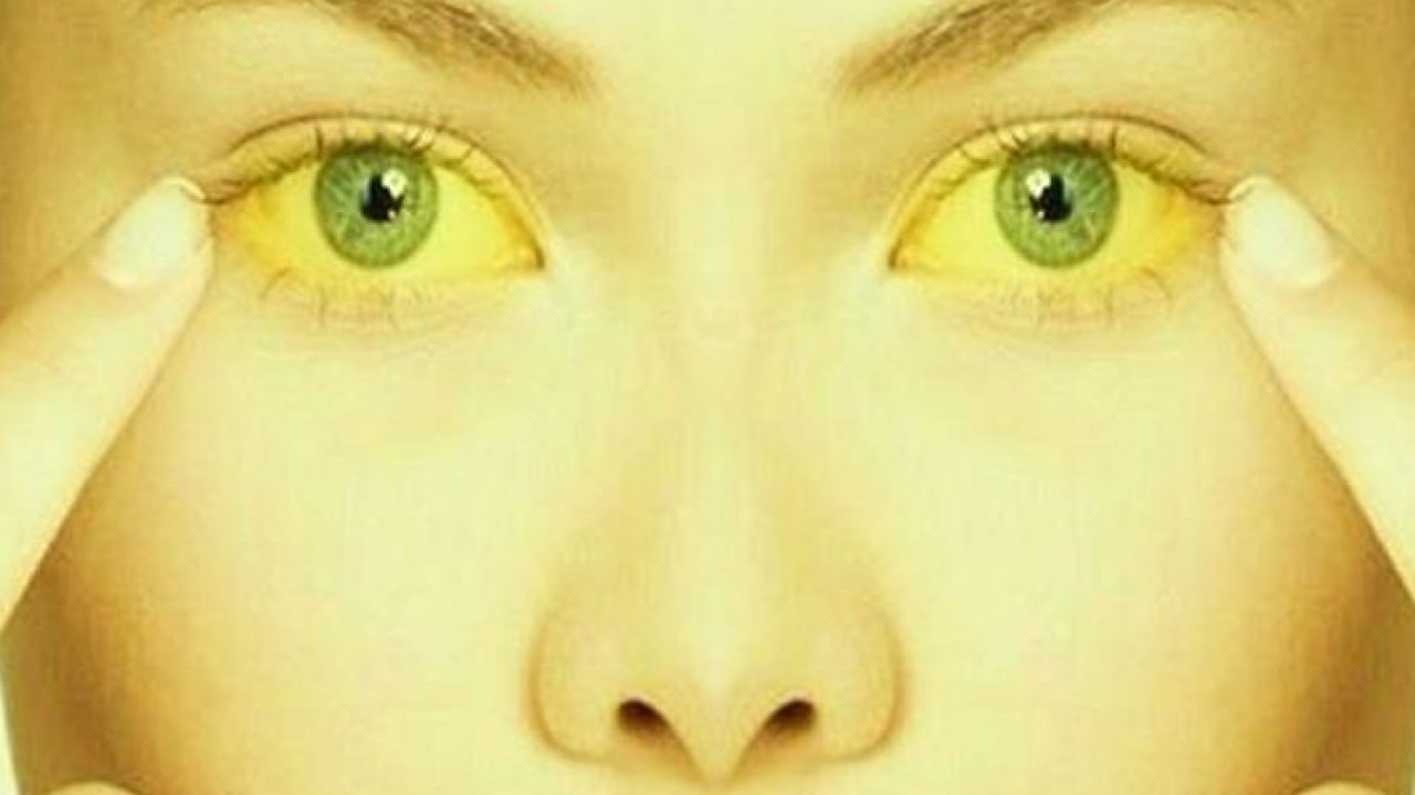 Синдром Жильбера желтые глаза
